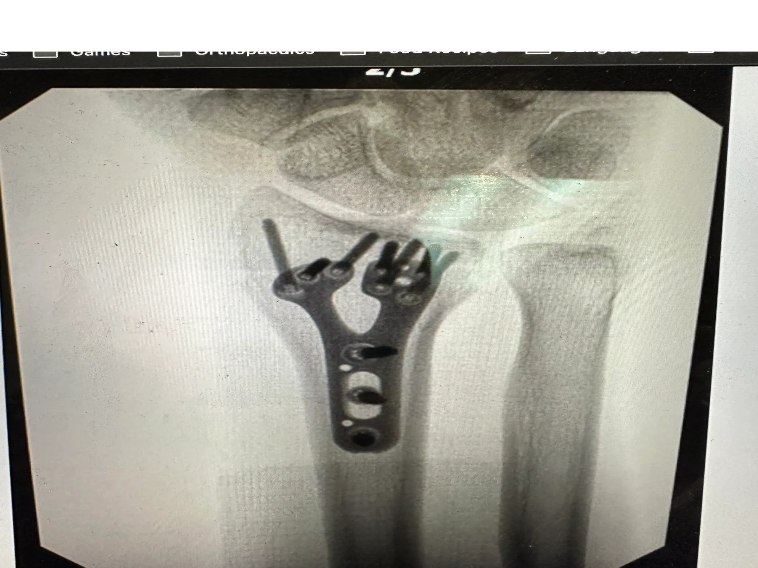 Hand and wrist orthopedic surgery