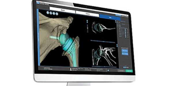 Shoulder surgery and CT scan imaging